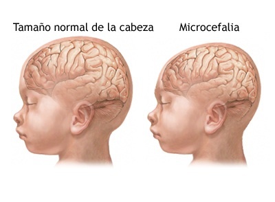 zika niños